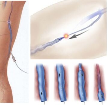 metoda léčby křečových žil - endovenózní laserová koagulace